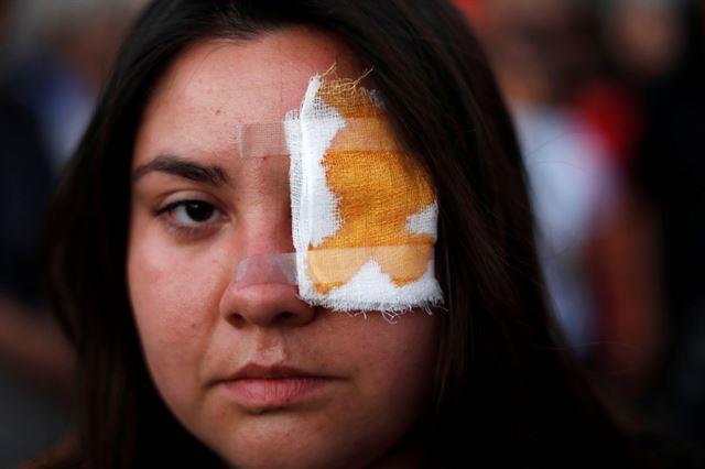 “칠레 경찰 발포 고무탄에 눈 부상자만 180명… 30%는 완전 실명”